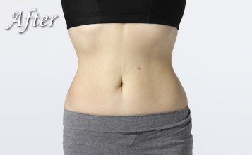 スリムボディー アフター