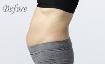 スリムボディー ビフォー